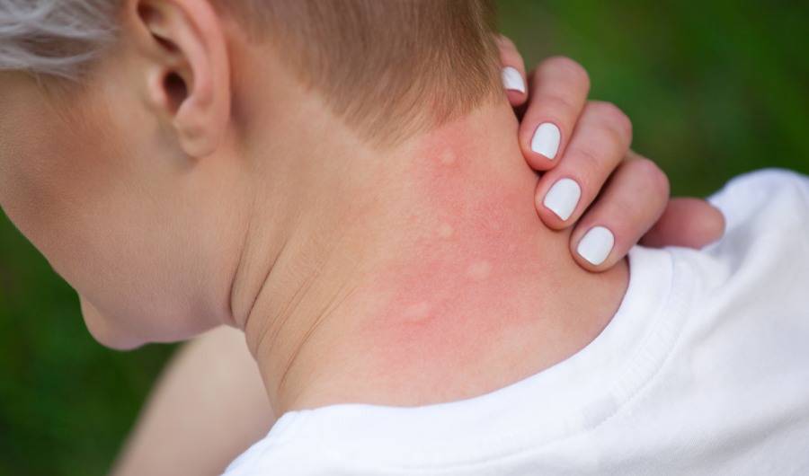 Niña de pelo rubio, sentada de espaldas y rascándose la piel mordida, enrojecida e hinchada del cuello por picaduras de mosquito en verano en el bosque. Primer plano de picaduras de insectos visibles. Piel irritada.